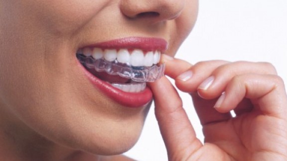 GInvisalign02 480x276