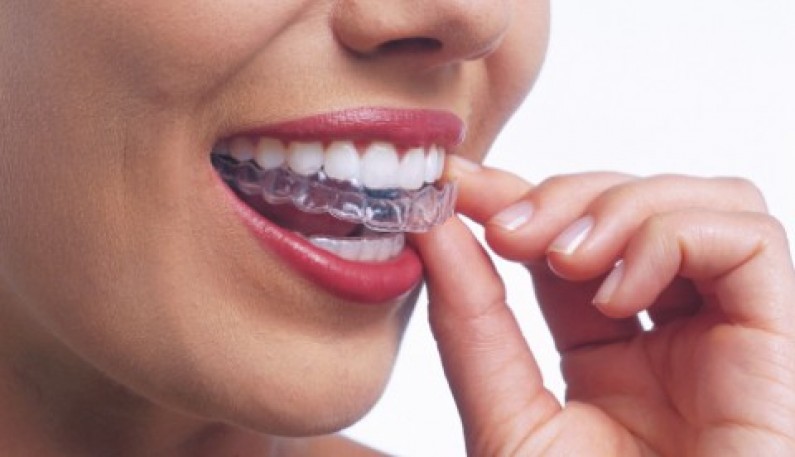 GInvisalign02-480x276.jpg